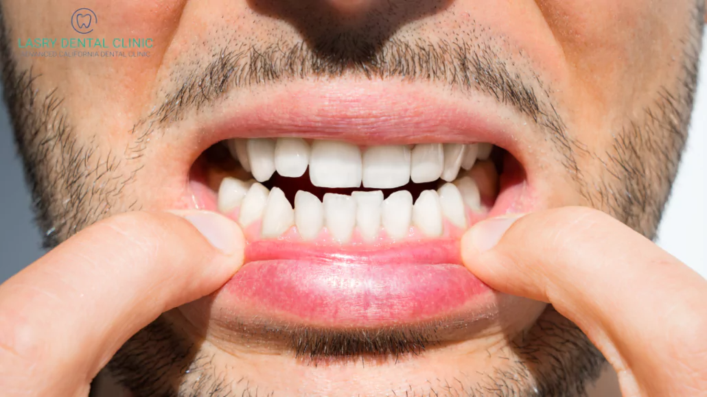 Invisalign for Crowded Teeth: Straighten with Ease
